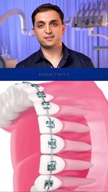 Костная ткань и брекеты