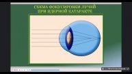 Офтальмология. Лекция №7. Патология хрусталика