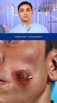 Опасность пирсинга щек