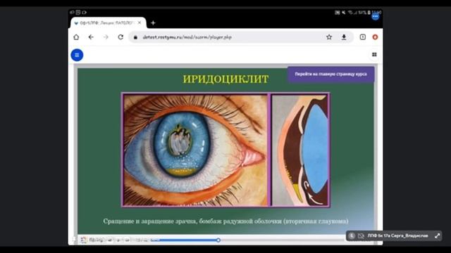 Офтальмология. Лекция №6. Патология сосудистой оболочки