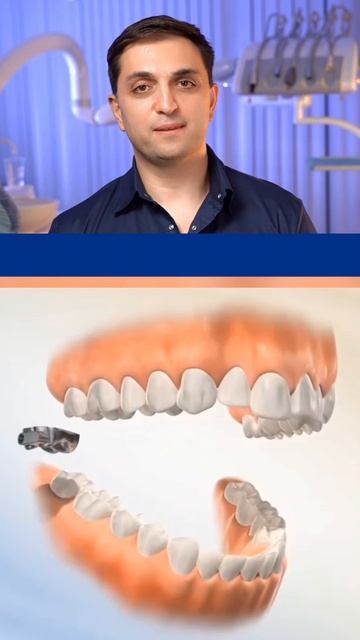 Аппарат Гербста