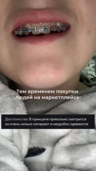 Новая мода ортодонтического лечения