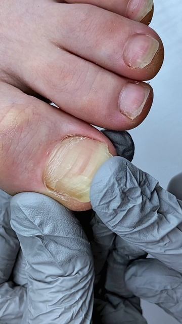 синдактилия + деформация ногтевой пластины из-за тесной обуви + обработка онихолизиса