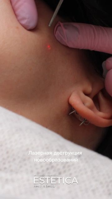 Лазерная деструкция новообразований