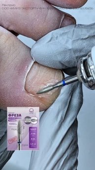 зачистка ‘краёв’ онихолизиса ❤️