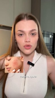 что не стоит делать, если у тебя акне?🤫