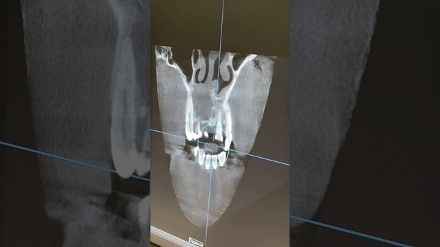 Крупная киста на зубе