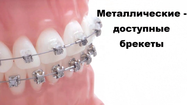 Исправление прикуса в Москве – доступные цены на брекеты
