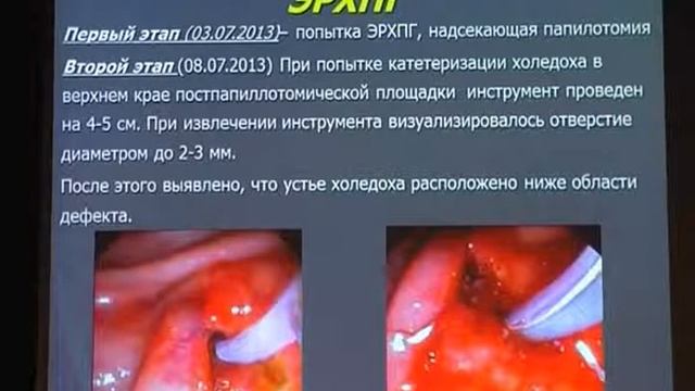 Первенство 20 Будзинский С А    Опыт эндоскопического лечения ретродуоденальной перфорации при ЭПСТ