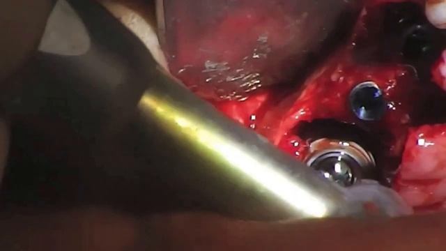 DENTAL CASE: Crestal Sinus Lift Live Implants Training l Live Implants Courses