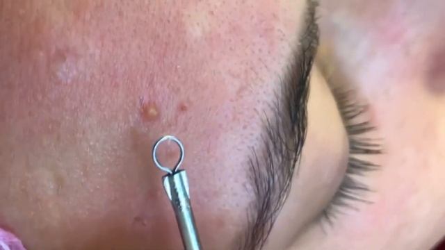 Satifying videos blackhead extraction  | removing cystic acne  |  черные  точки | акне