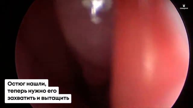 Интересные находки в носу и ухе. Видео изнутри