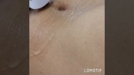 Лазерная эпиляция живота диодным лазером 720