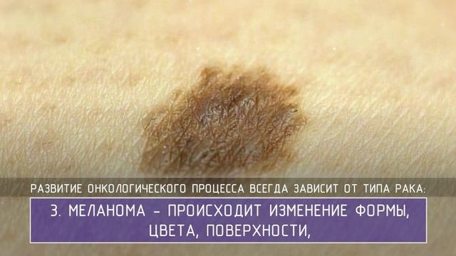 Рак кожи