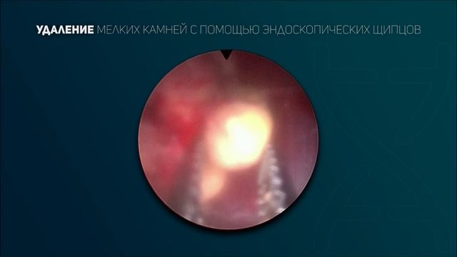 Лазерная литотрипсия. Видео 4.