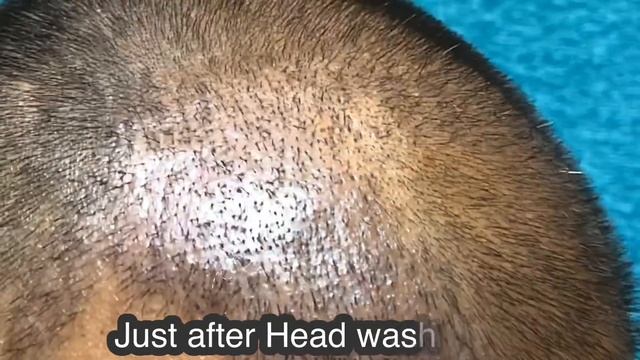 How scalp look after 10th day of Hair Transplant?