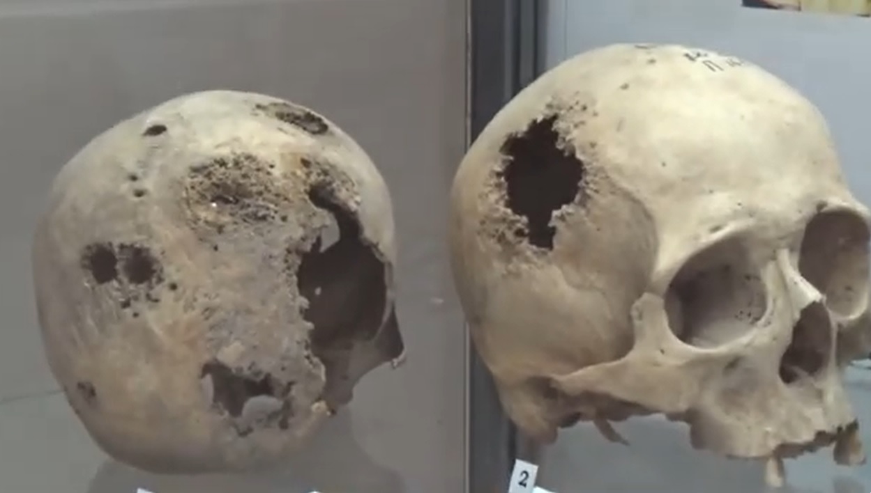 Человеческие останки со следами сифилиса из раскопок некрополя турецкого Азова