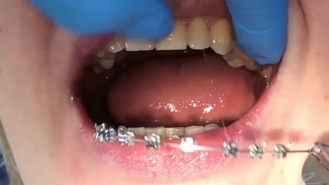 Как отбелить зубы?! И что поможет избавиться от проблем с зубами?