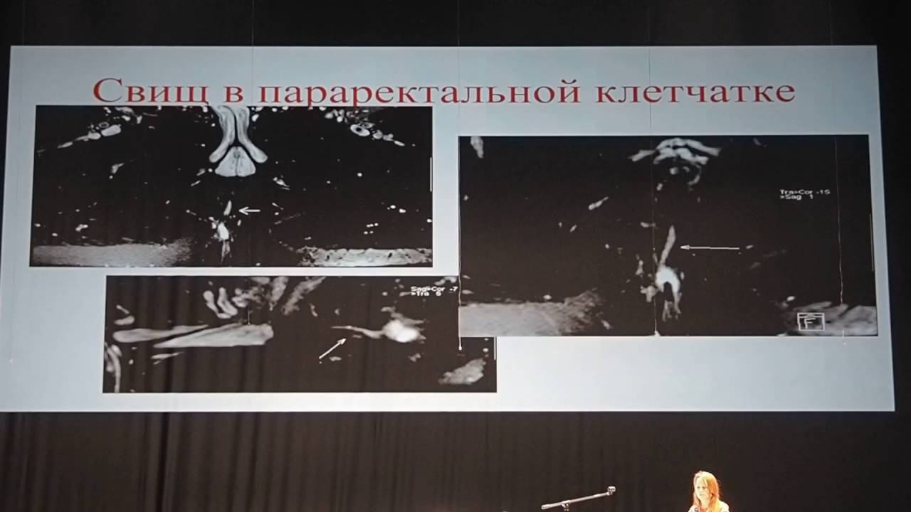 14 Горбачева ДШ   Мультидисциплинарный подход к лечению перианальной болезни Крона