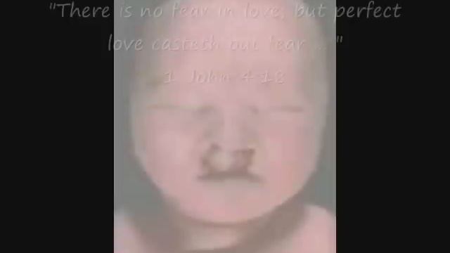 trisomy 13