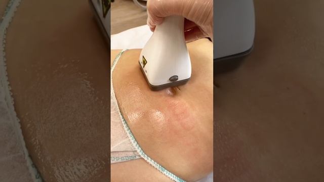 LPG массаж, лпг массаж, лпджи массаж, вакуумно-роликовый антицеллюлитный массаж в салонах Софт Эпил
