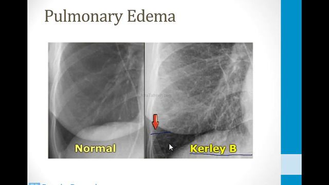 Pulmonary - 3. Other Pulmonary Topics - 9.Chest x-rays atf