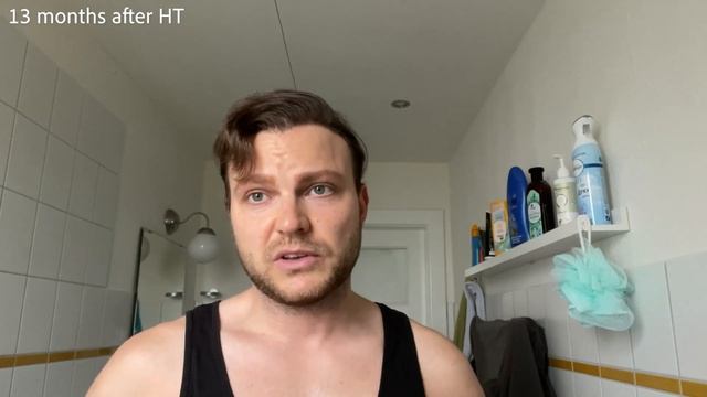13 months after hairtransplant - Elithairtransplant Dr. Balwi Turkey