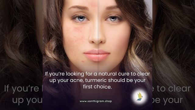 Acne? No problem! Turmeric is a powerful ingredient that helps in clearing up acne and pimples.