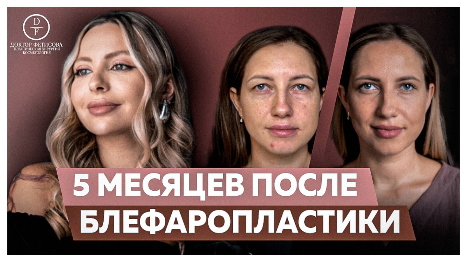 5 МЕСЯЦЕВ ПОСЛЕ БЛЕФАРОПЛАСТИКИ
