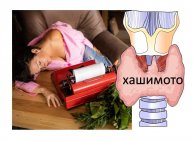 АутоИммунный тиреоидит (АИТ): реальные причины и следствие