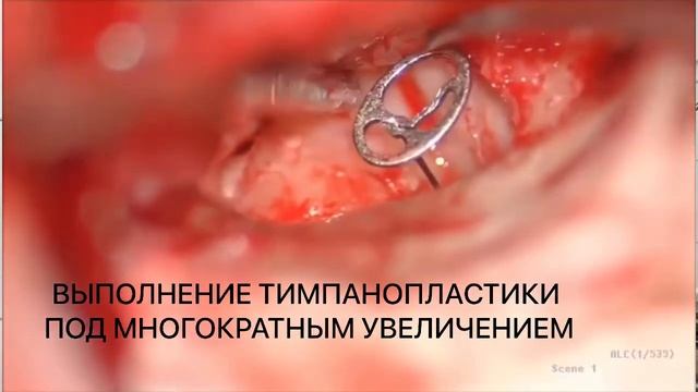 Благодарность оториноларингологическому отделению РКБ им. Н.А. Семашко