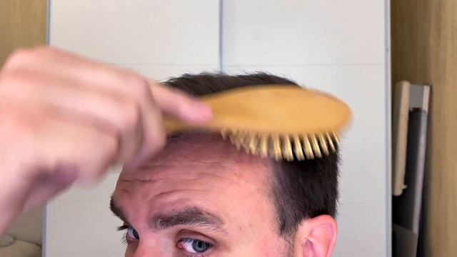 Как выглядят пересаженные волосы и спустя три года. Видео отчёт!