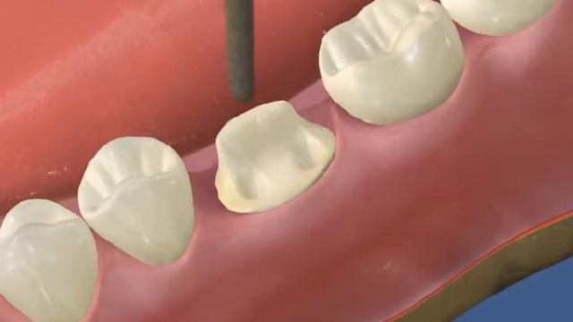 Установка культевой вкладки и коронки при глубоком разрушении зуба в ЭликсКлиник