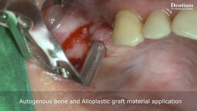 Hydraulic Sinus Elevation & Implantation With Dentium Digital Guide Dr.Hyun-ki Roh