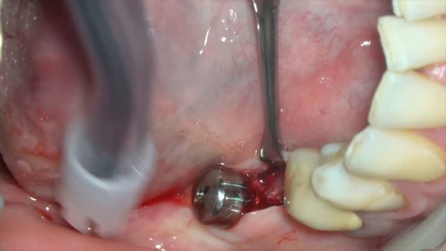 Установка формирователей десны на имплантаты Dentium в области зубов 4.6 4.7.