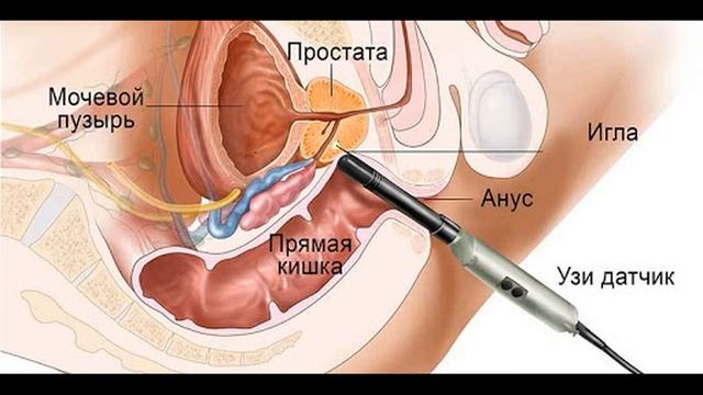 простата усмаси. (саротон)