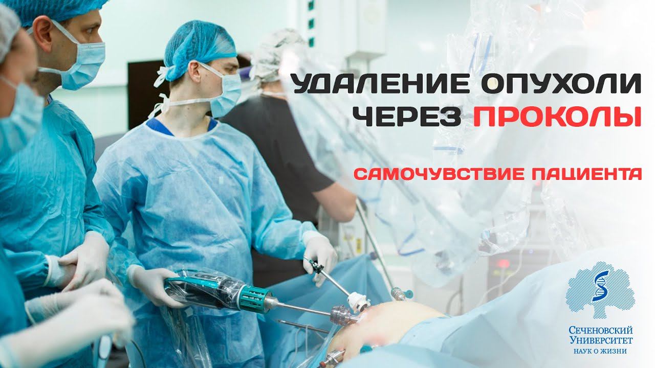 Удаление опухоли кишки через проколы