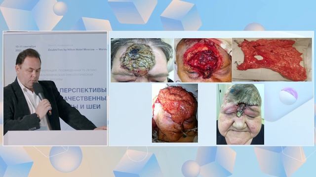 Современный подход в лечении больных местно-распространенным базальноклеточным раком. - Поляков А П