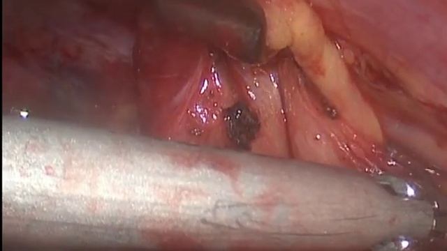 Удаление вилочковой железы, торакоскопия. 250416. Thymus extirpation.