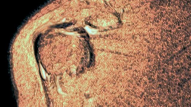 Long Head of Biceps Pathway and tendinitis : 3D MRI FInding