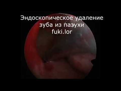 Эндоскопическое удаление зуба из пазухи, ЛОР-операция, оперирует лор к.м.н. Фуки Евгений Михайлович