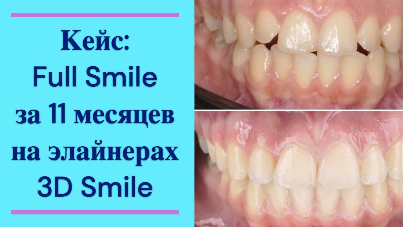 Кейс Full Smile за 11 месяцев на элайнерах 3D Smail