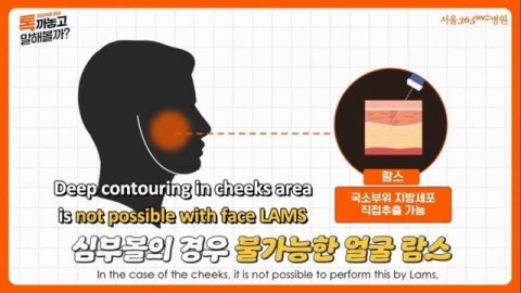 Facial Liposuction Q&A Session!! (With Director Seo Sung Ik)