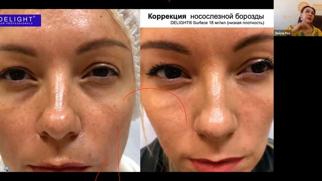 Линейка премиальных израильско-швейцарской филлеров Delight для врачей косметологов, урогинекологов