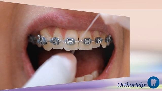 Como utilizar passa-fio ou Superfloss.