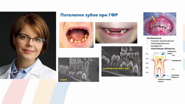 Куликова К.С. Гипофосфатемический рахит в практике педиатра, эндокринолога, ортопеда и стоматолога.