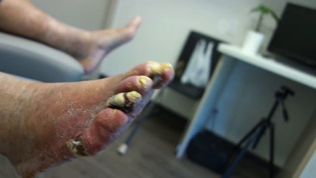 GANGRENE TOE ON A DIABETIC PATIENT