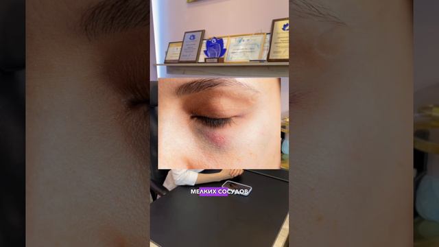 Отеки и синяки после операции