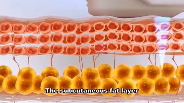 4D HIFU treatment by top beauty