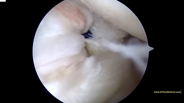 R Shoulder subscapularis repair and biceps tenodesis 8.11.2016 NW